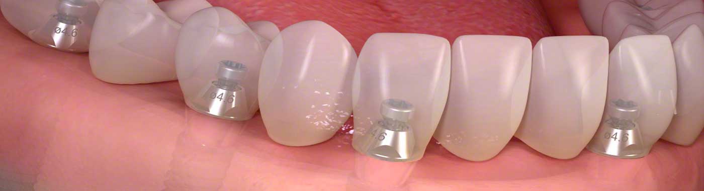 protesi-su-impianti-dentro-dentistico-sarca